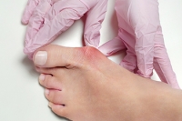Will Bunions Go Away on Their Own?