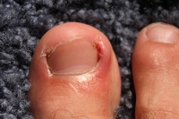 Managing Ingrown Toenails