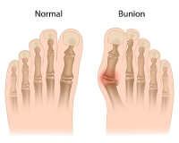 How Runners Can Address Troublesome Bunions