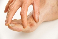 Can Bunions Be Treated?