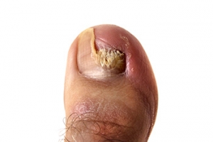 Toenail Fungus Needs Treatment