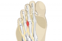 Morton’s Neuroma in Runners and Others