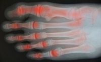 Several Types of Arthritis Can Affect the Feet