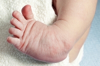 Long-Term Consequences of Congenital Clubfoot